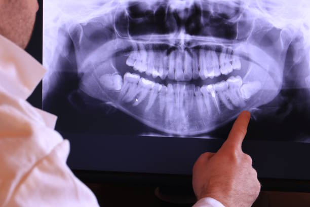 Best Emergency Wisdom Teeth Removal in Cannon Af, NM