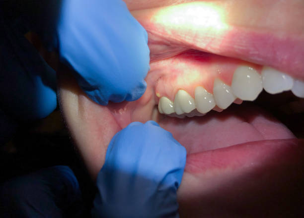 Best Emergency Dental Care for Broken or Chipped Teeth in Cannon Af, NM
